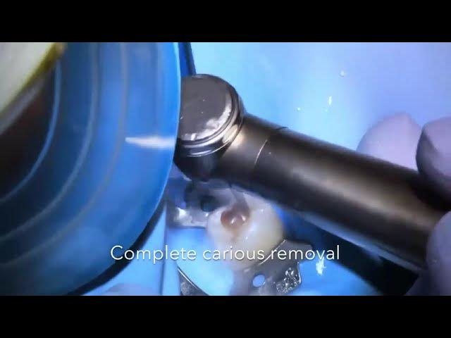 Video thumbnail for pulpotomy for primary tooth step by step