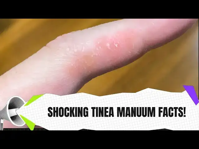Video thumbnail for What Is Tinea Manuum? 🧼 | Causes, Symptoms & Treatment Explained