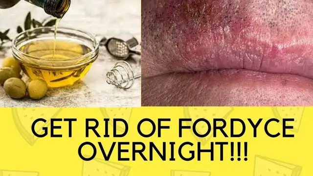 'Video thumbnail for How To Get Rid Of Fordyce Spots On Lips And Shaft Overnight Naturally Fast At Home'