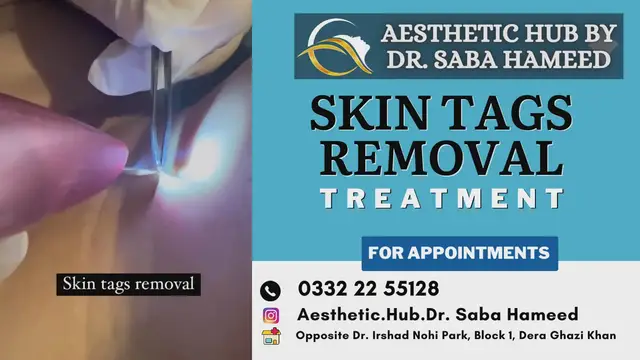 'Video thumbnail for Skin Tag Removal'