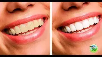 'Video thumbnail for 10 Natural Ways to Whiten Your Teeth and Prevent Gum Disease'