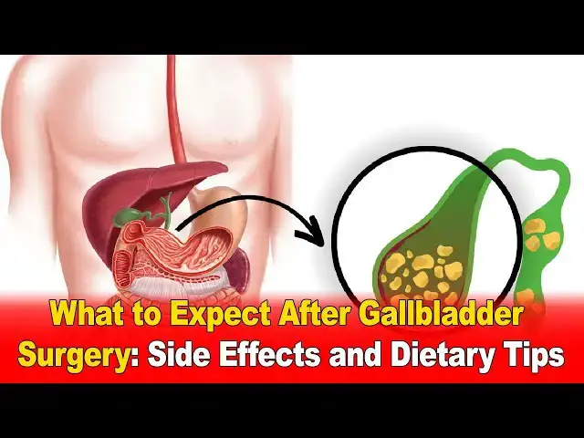Video thumbnail for What to Expect After Gallbladder Surgery 🏥 | Side Effects & Dietary Tips