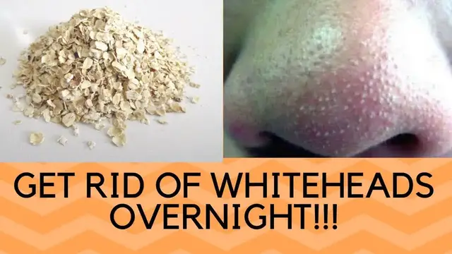 'Video thumbnail for How To Remove Tons Of Blackheads & Whiteheads Instantly! Home Remedies'