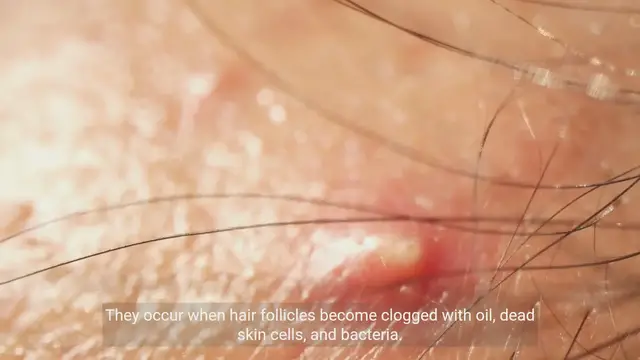 Video thumbnail for Dealing with Pimples: Effective Tips and Remedies