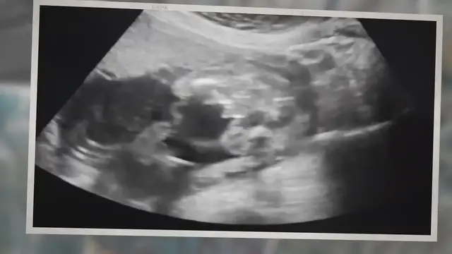 Video thumbnail for Shelf Life of Mifepristone and Misoprostol