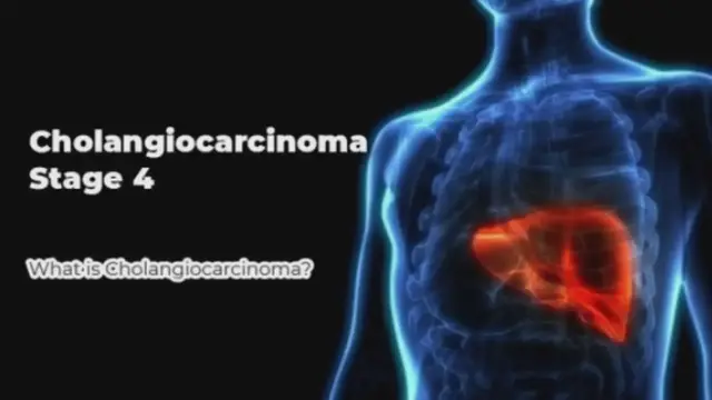 Video thumbnail for Cholangiocarcinoma Final Stage