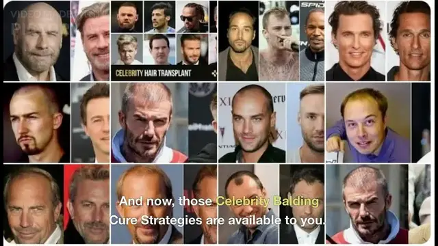 'Video thumbnail for Balding Celebrity With Hair Transplants: Reveals Hollywood hair loss Secret'