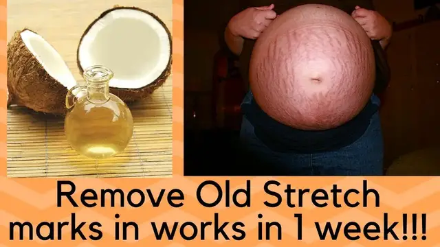 'Video thumbnail for How To Remove Old Stretch Marks( FAST IN A WEEK!!!)'