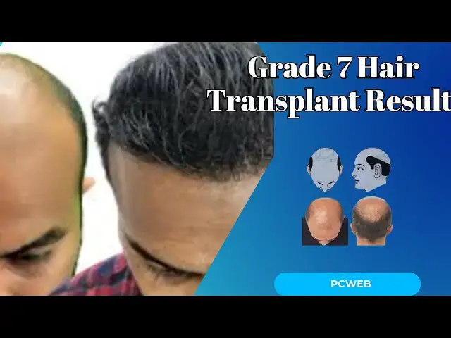 Video thumbnail for Grade 7 Hair Transplant Results: Achieving Full Coverage with Advanced Techniques