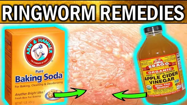 Video thumbnail for 8 Best Natural Home Remedies For RINGWORM TREATMENTS