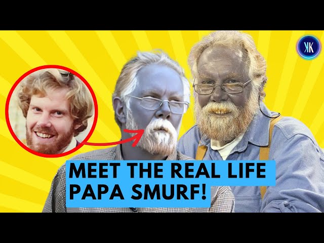 Video thumbnail for He Tried To Cure His Disease And Turned Himself Blue