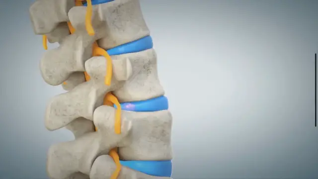 Video thumbnail for Débord discal: Que faire ? (causes et traitements naturels)