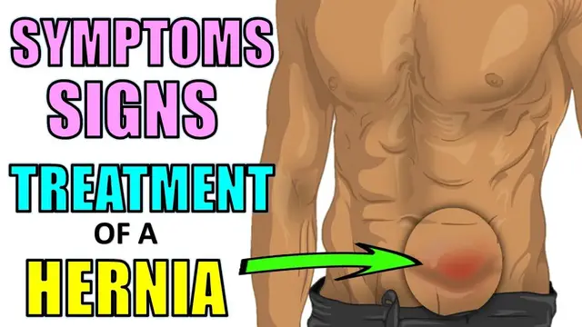 Video thumbnail for Signs &  Symptoms of a Hernia | Home Treatments of Hernias