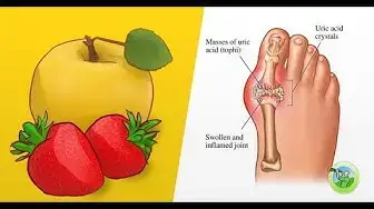 'Video thumbnail for Top 7 Fruits That Help Lower Uric Acid Levels And Prevent Gout'