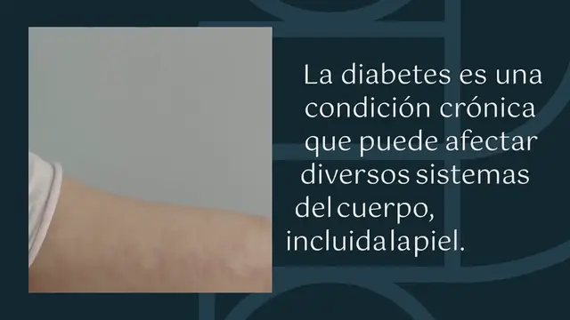 Video thumbnail for Estas son las problemáticas en la piel más comunes en personas que sufren diabetes (y no la tratan)