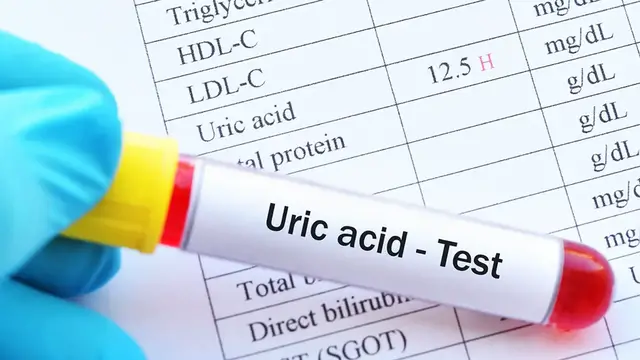 Video thumbnail for Ácido úrico, qué no debo comer; video blog