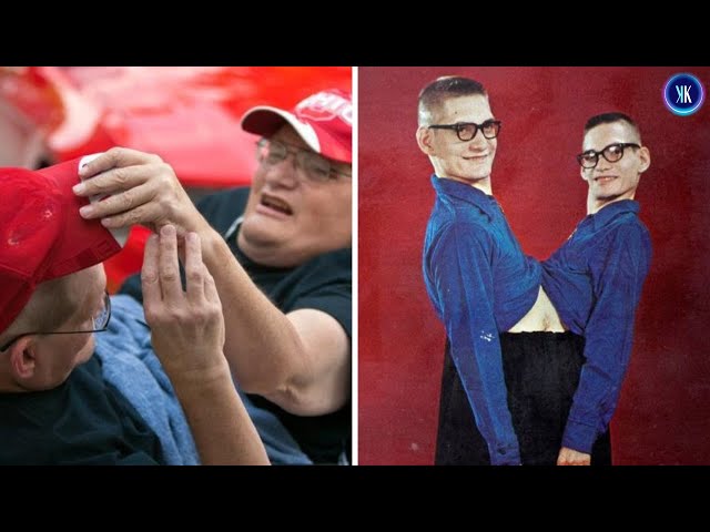 Video thumbnail for Conjoined Twins Are the Complete Opposites of Each Other
