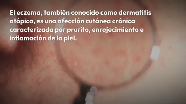 Video thumbnail for Eczema – dermatitis atópica: causas y remedios naturales