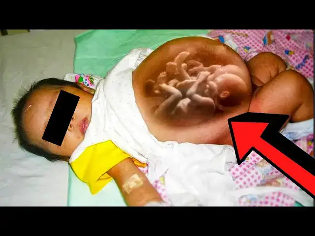 Video thumbnail for This Woman Became Pregnant While Pregnant, Now She Has Miracle Twins