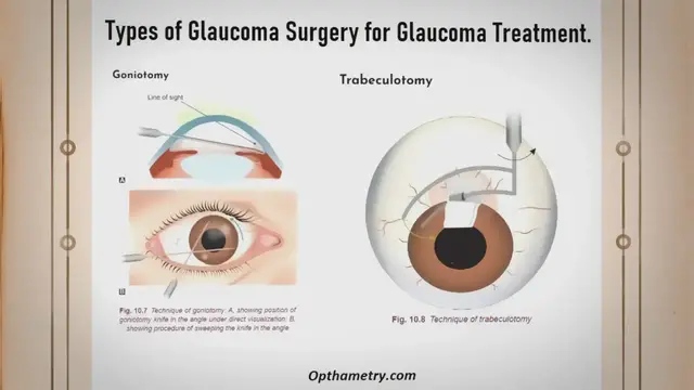 Video thumbnail for Types of Glaucoma Surgery for Glaucoma Treatment. - An Eye Care Blog