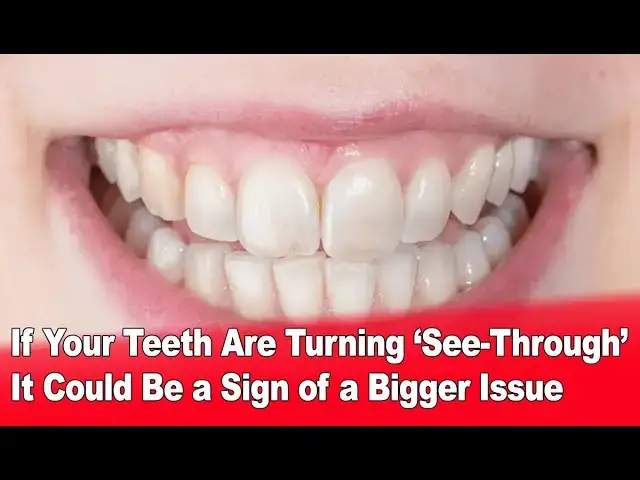 Video thumbnail for If Your Teeth Are Turning ‘See-Through’ It Could Be a Sign of a Bigger Issue 🦷⚠️