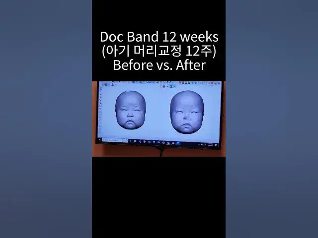 Video thumbnail for 신생아 교정헬멧 착용 후 머리모양 변화 (사두증, 단두증)