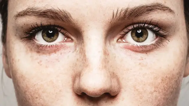 'Video thumbnail for The Truth About Freckles'