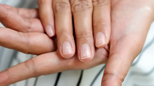Video thumbnail for Nail Changes You Should Never Ignore
