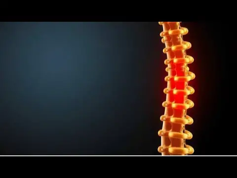 Video thumbnail for ¿Qué es la Artrosis Lumbar y Cómo Afecta tu Calidad de Vida?