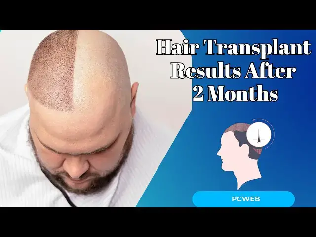 Video thumbnail for Hair Transplant Results After 2 Months: What You Should Expect and Why Patience Pays Off