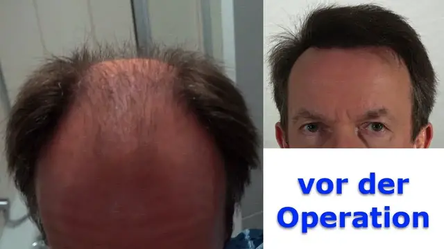 Video thumbnail for Teil 1: Ablauf einer Haartransplantation in Istanbul - Vor der Operation