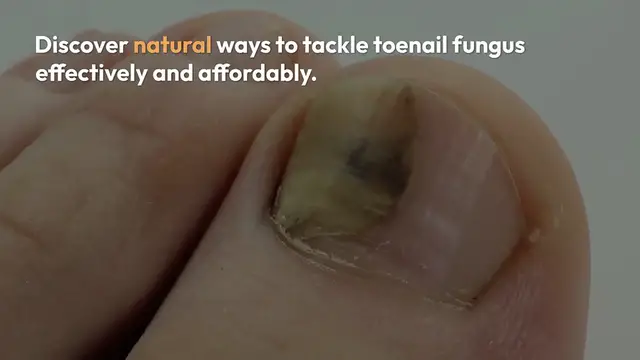 Video thumbnail for Natural_Toenail_Fungus_Remedies
