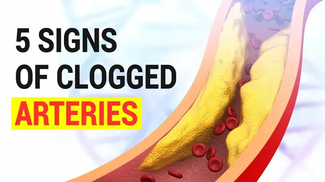 'Video thumbnail for 5 Signs Of Clogged Arteries'