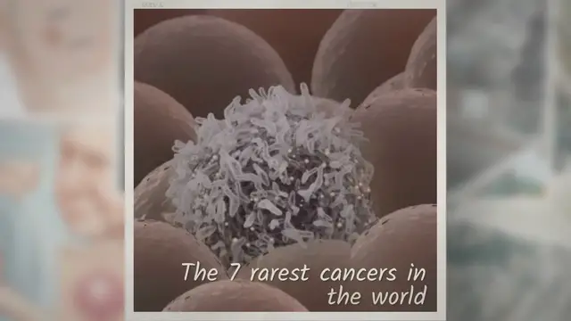 Video thumbnail for 7 Rarest Cancers in the World In 2023