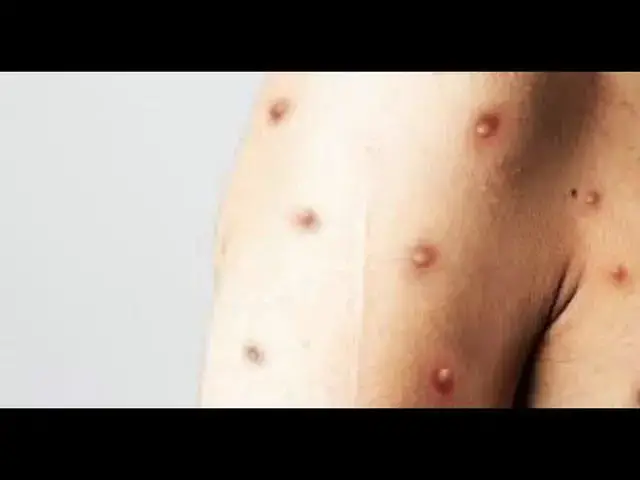 Video thumbnail for MAJMUNSKE BOGINJE  - SIMPTOMI