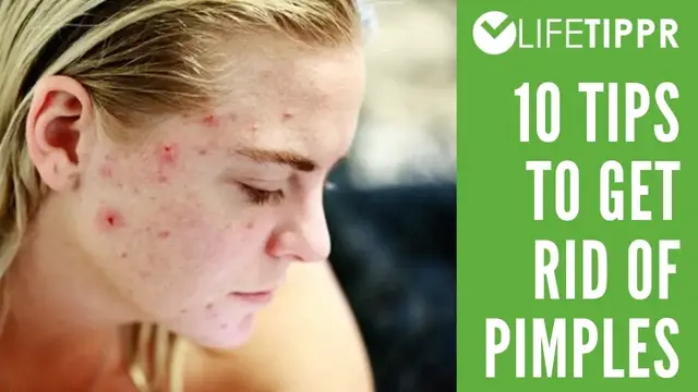 Video thumbnail for Top 10 Tips To Remove Acne (Pimples) and Blackheads