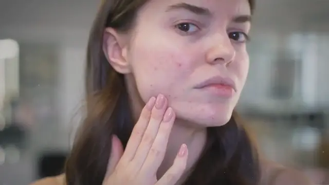 'Video thumbnail for Blackheads: Unmasking the Causes, Debunking Myths, and Mastering Removal and Prevention'