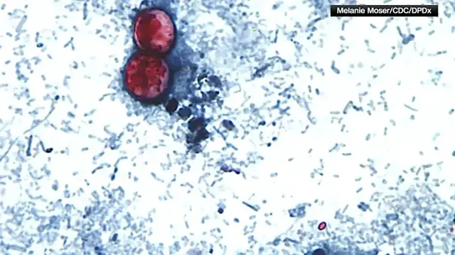 Video thumbnail for Suffolk County reporting over twice as many cyclosporiasis cases as Nassau County