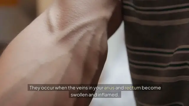 Video thumbnail for Natural Remedies for Hemorrhoids