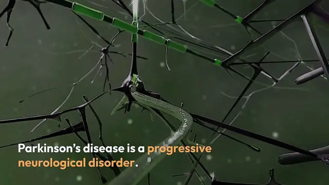 Video thumbnail for Early Signs of Parkinson's Disease