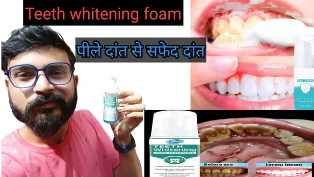 'Video thumbnail for Teeth Whitening FoamToothpaste Review/ Yellow Teeth Solution लेने से पहले यह विडियो जरूर देखे'