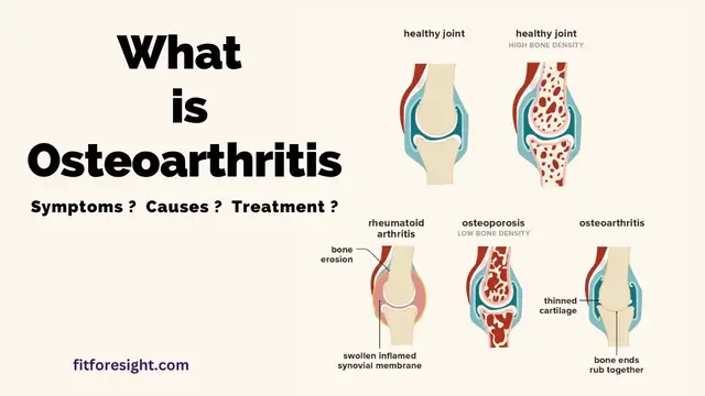 'Video thumbnail for What is Osteoarthritis ? Symptoms , Causes , Treatment .'