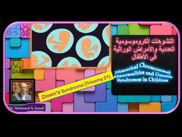 Video thumbnail for التشوهات الكروموسومية العددية والأمراض الوراثية في الأطفال  Numerical Chromosomal  Abnormalities