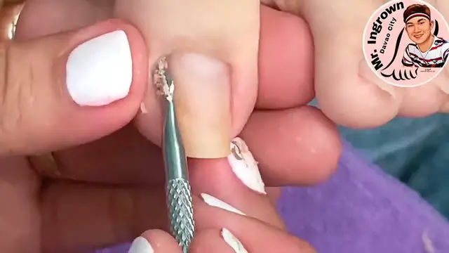 Video thumbnail for Full of dry skin and Ingrown (But Beautiful Nail with Nail polish output).