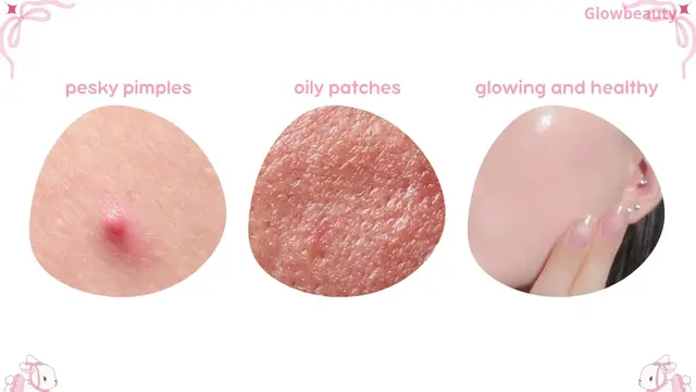 'Video thumbnail for how to get rid of pimples | skincare |skincare routine | acne prone skin'