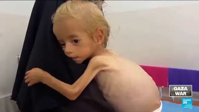 'Video thumbnail for Toddler evacuated from Gaza recovers from malnutrition in Italian hospital'