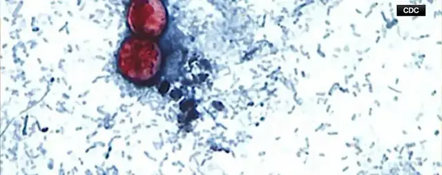 Video thumbnail for Up to 200 cyclosporiasis cases reported in New Jersey