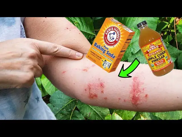 'Video thumbnail for Escape the POISON IVY ITCH: Natural Home Remedies for Poison Ivy Rash'