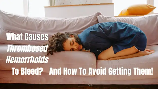 'Video thumbnail for What Are Thrombosed Hemorrhoids?'