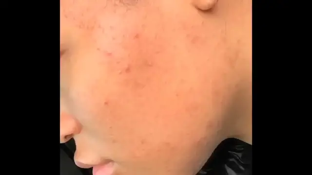 Video thumbnail for HOW I CLEARED MY ACNE FOR GOOD IN ONE WEEK (NO ACCUTANE) + SKINCARE GIVEAWAY SKINCARE ROUTINE 2023